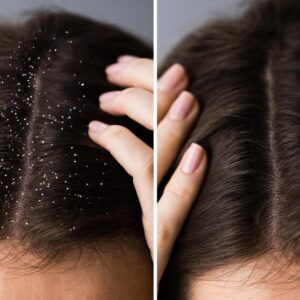 Hair Dandruff Treatments